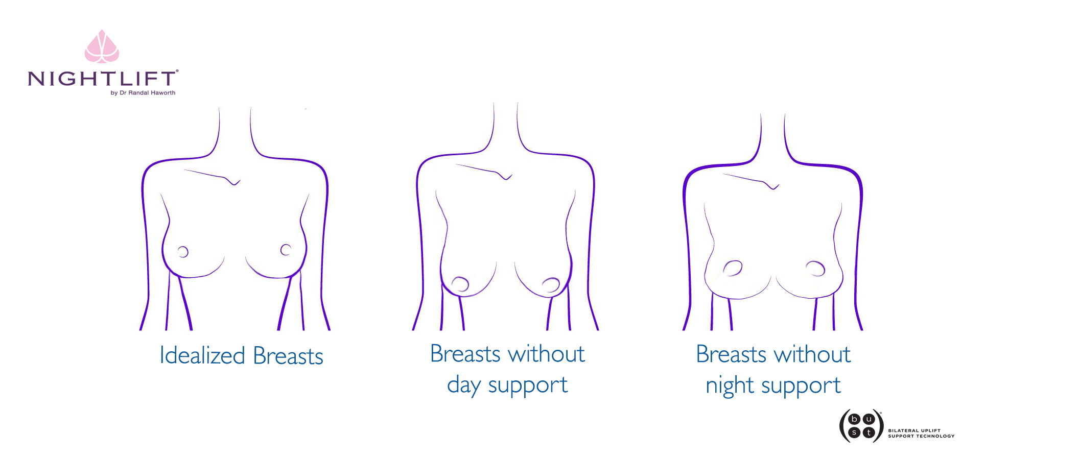 Breast Lift Expert, Types of Droop
