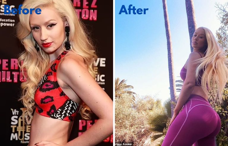 Iggy Azalea Before And After Plastic Surgery Transformation And What Kind Of Surgery She Got Dr 7835